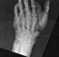 X-ray of injured man’s damaged hand